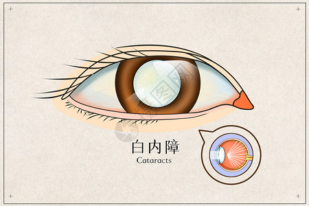 中医眼科白内障医疗插画插画