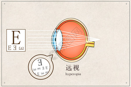 人体分析图表远视医疗插画插画