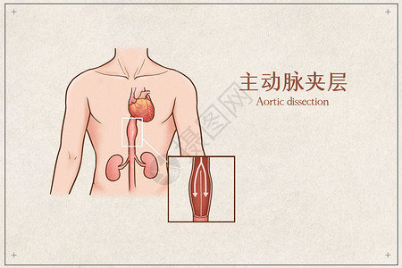 人体分离主动脉夹层医疗插画插画