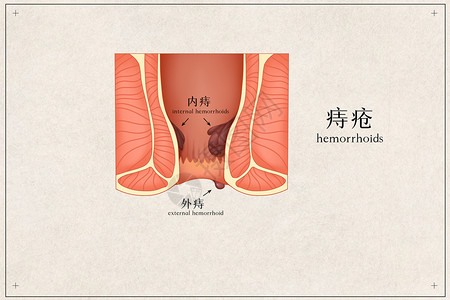 痔疮医疗插画高清图片