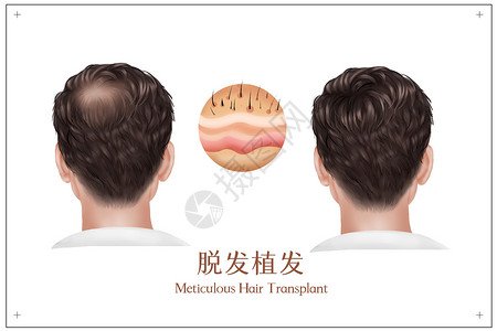 掉发严重男性脱发植发医疗插画