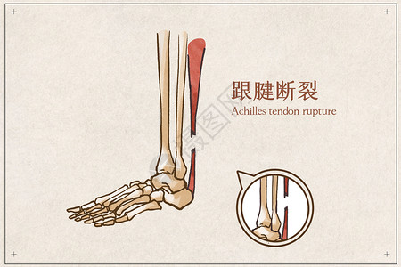 跟腱断裂病例医疗插画高清图片