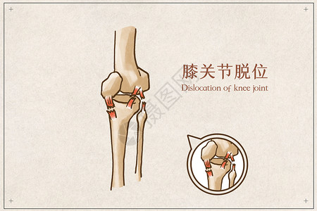 膝关节脱位软组织骨连接高清图片