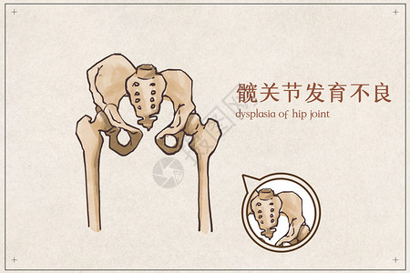 骨盆聚合髋关节发育不良插画