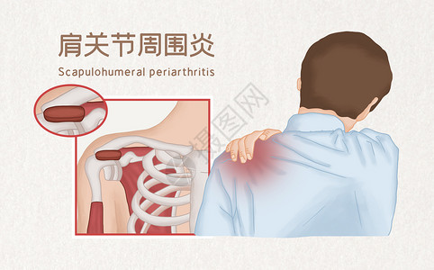 肩部运动肩关节周围炎医疗插画插画