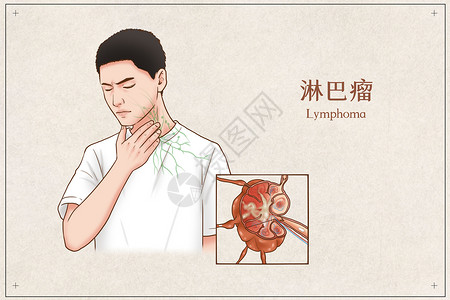 人体鼻子内部结构淋巴瘤医疗插画插画
