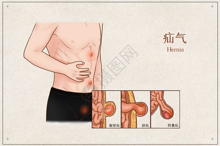 疝气医疗插画高清图片