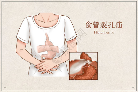 胃食管食管裂孔疝医疗插画插画