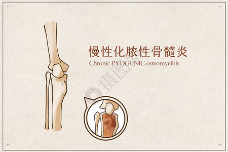 人体解剖学慢性化脓性骨髓炎插画