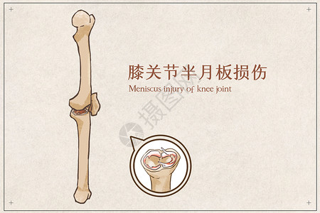 膝关节半月板损伤插画