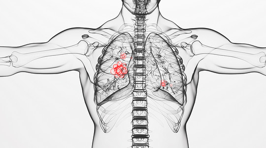 呼吸系统疾病人体肺部病变场景设计图片