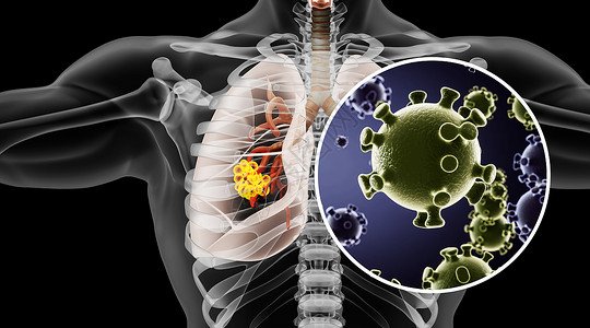 非小细胞肺癌人体肺部病变场景设计图片