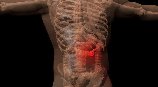肠炎人体肠胃病变场景设计图片
