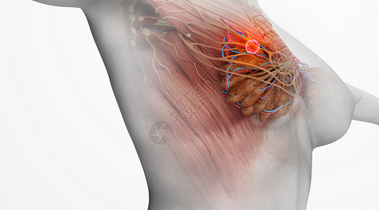 乳腺癌病变场景图片
