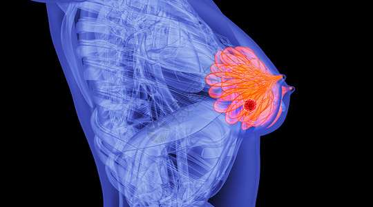 胸部器官人体乳腺病变场景设计图片