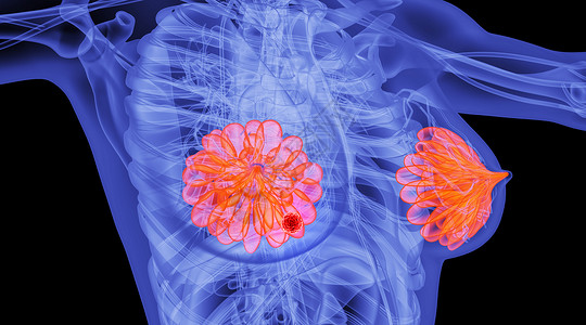 胸部肿瘤人体乳腺病变场景设计图片