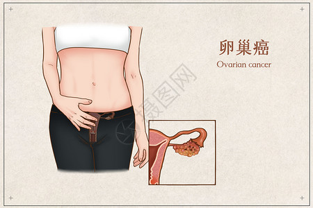 卵巢癌医疗插画图片