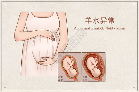 孕妇看病羊水异常医疗插画插画