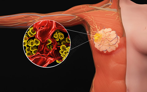 乳腺淋巴人体女性乳腺病变设计图片
