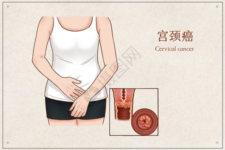 宫颈癌医疗插画图片