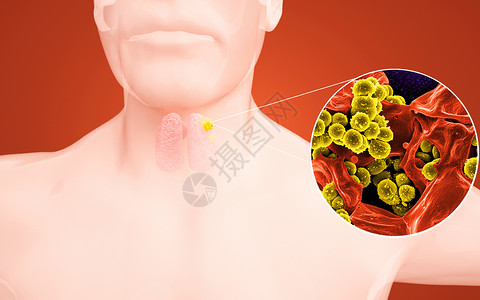 人体甲状腺感染图片