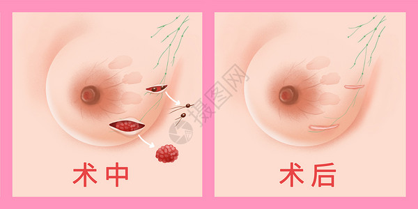 袖状胃切除手术乳腺癌保乳手术医疗插画插画