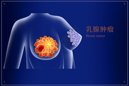 乳腺癌乳腺肿瘤医疗插画图片