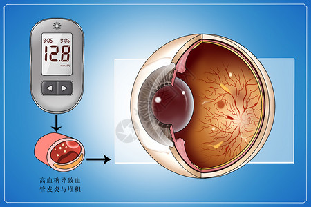 视网膜血管糖尿病并发症视网膜病变医疗插画插画