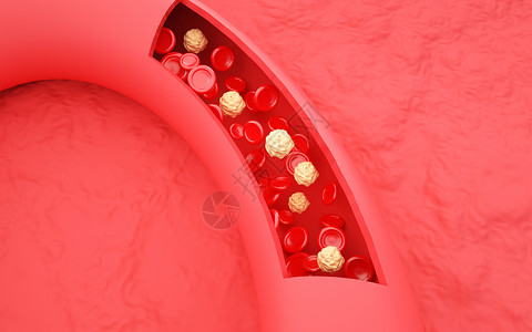 酒精性脂肪肝血液杂质设计图片