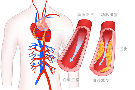 高血压血管病变医疗插画背景图片