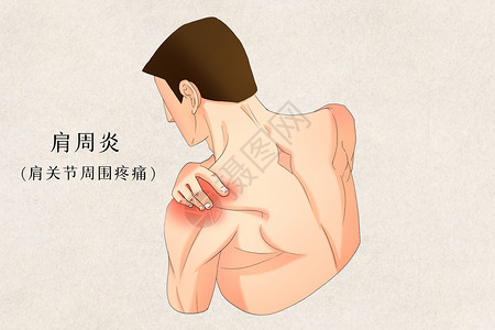 肩周炎肩关节周围疼痛症状二背景图片