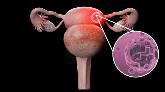 输卵管结扎术子宫病变场景设计图片