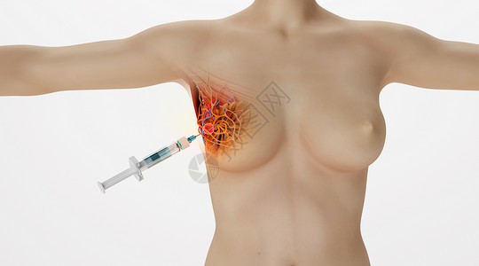肿瘤靶向治疗人体乳腺病变场景设计图片