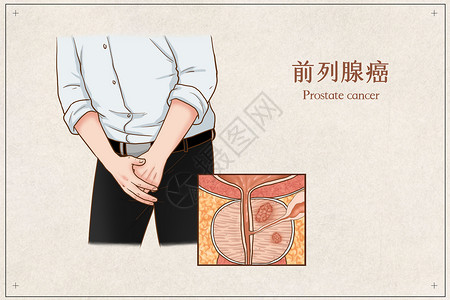 前列腺癌医疗插画高清图片