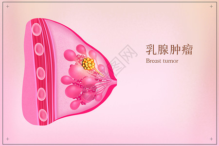 乳腺肿瘤医疗插画高清图片