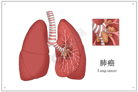 照射癌细胞肺癌肺部病变医疗插画插画