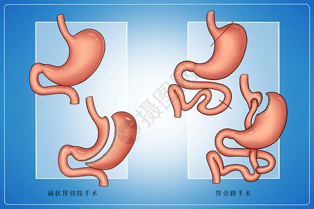 振袖糖尿病手术治疗医疗插画插画