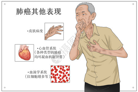 肺癌其他症状表现医疗插画图片