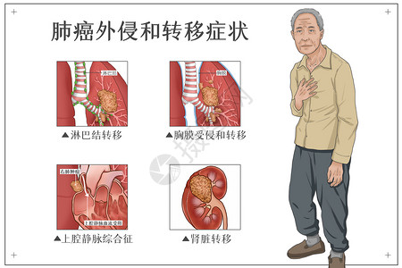 肺癌外侵和转移症状医疗插画高清图片