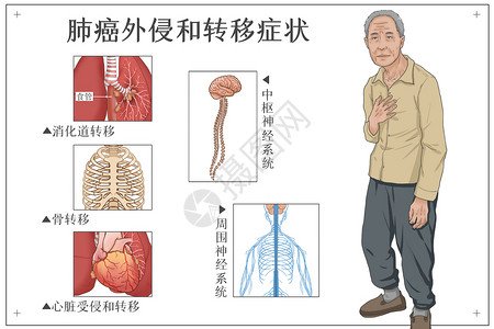 肺癌外侵和转移症状医疗插画图片