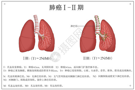 一期一会肺癌发展阶段医疗插画插画