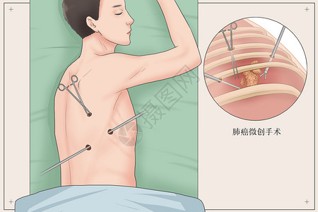 微创植肺癌的外科治疗医疗插画插画