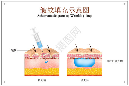 面部整形皮肤美容之皱纹填充插画