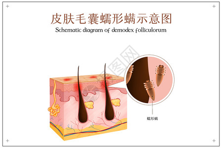 毛囊结构毛囊蠕形螨引发皮肤炎症插画
