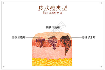 皮肤病变皮肤癌症类型示意图插画