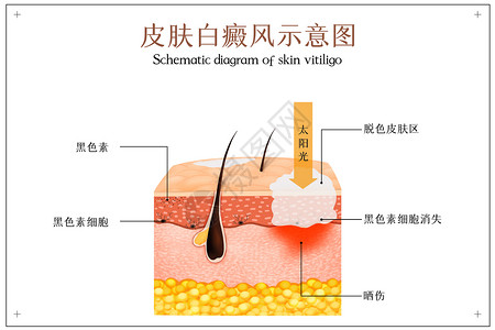 淡化黑色素皮肤白癜风示意图插画