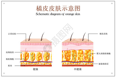 人体细胞结构橘皮皮肤示意图插画