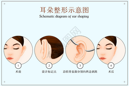 扩香耳朵整形示意图插画