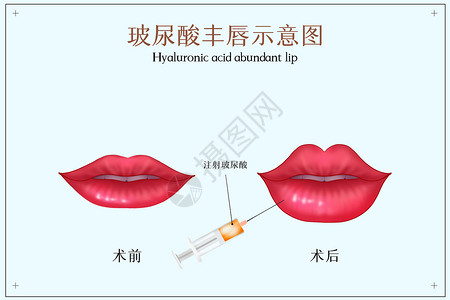 玻尿酸整形丰唇示意图插画