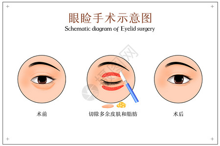 眼袋手术眼睑手术示意图插画